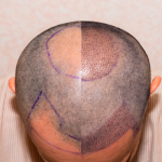 12 Things to Consider After Hair Transplantation