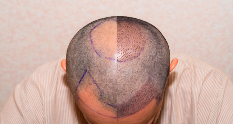 12 Things to Consider After Hair Transplantation