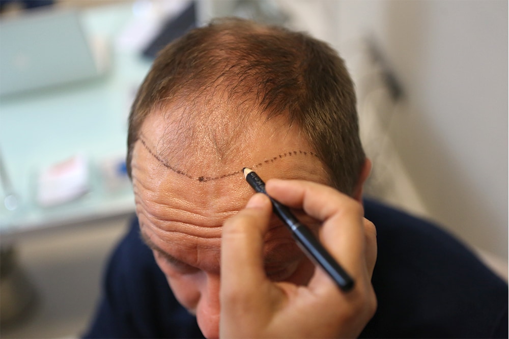 hair cut after hair transplantation