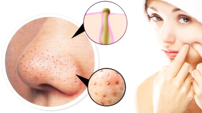 blackheads acne