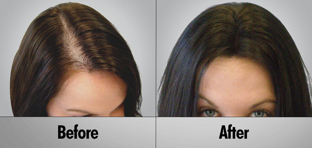 hair transplant woman