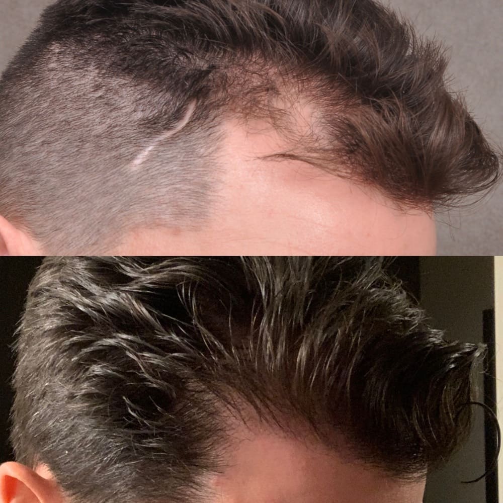 hair transplant before after