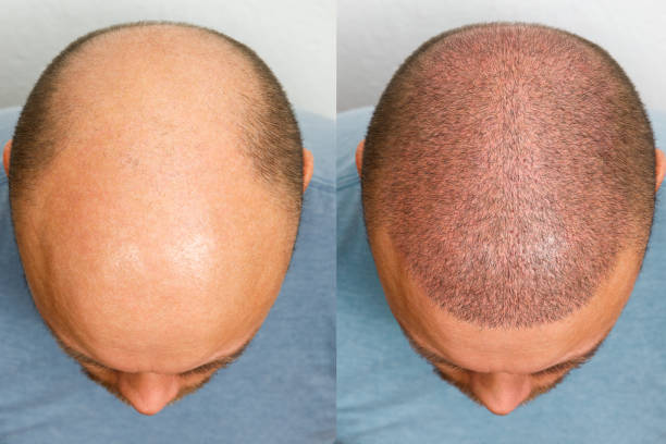 hair-transplantation