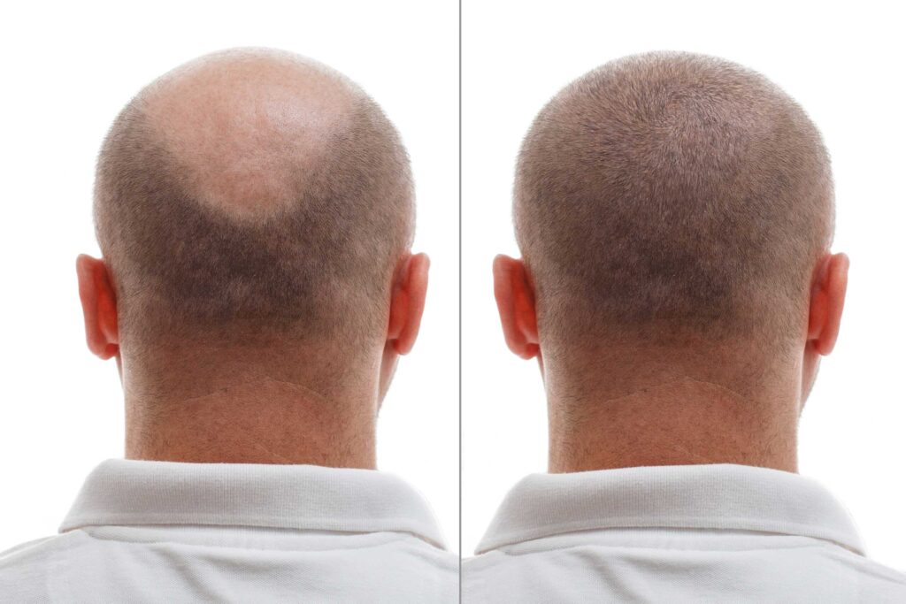 hair transplantation before after