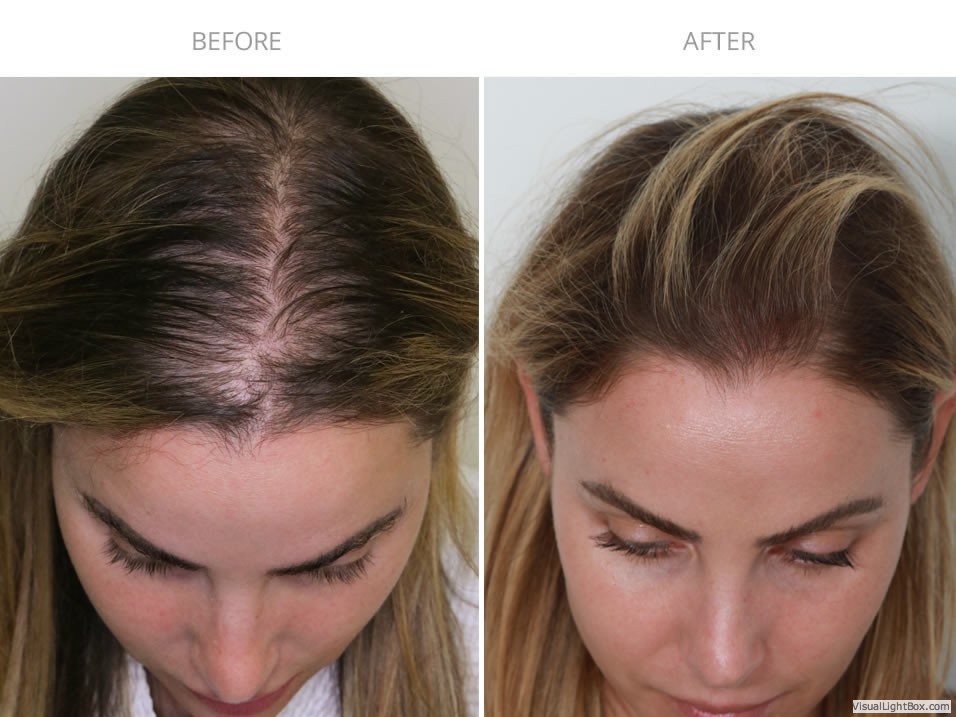 woman hair transplant