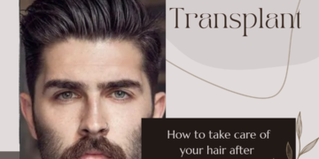 hair transplant