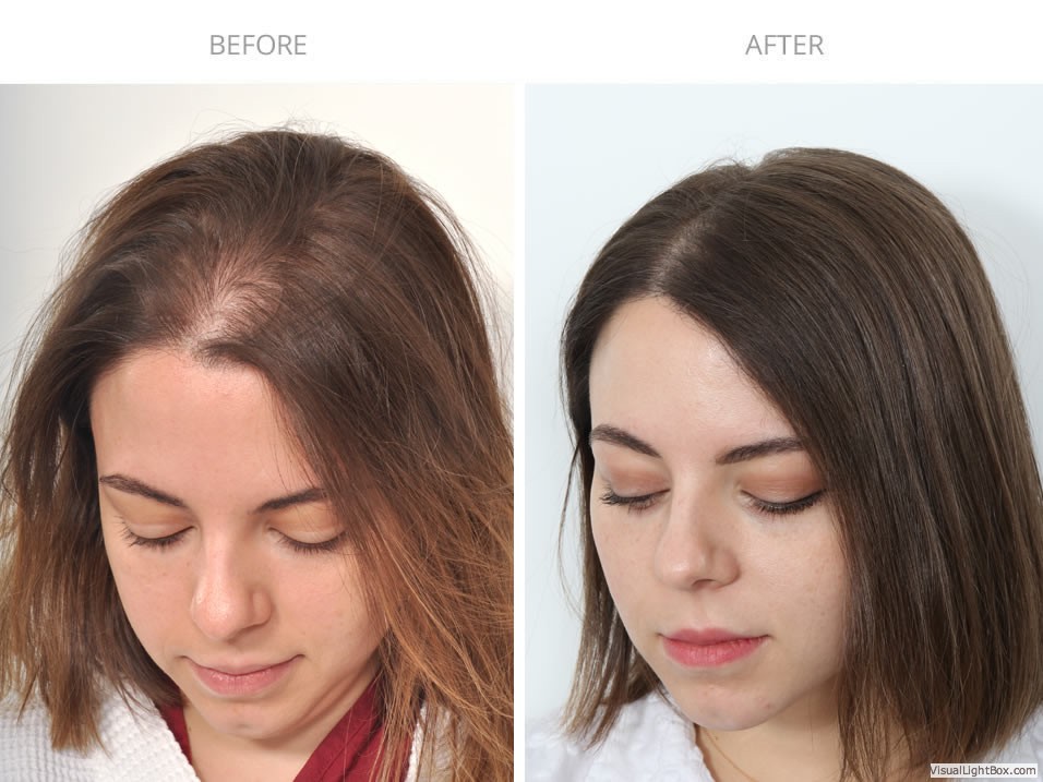 woman hair transplantation